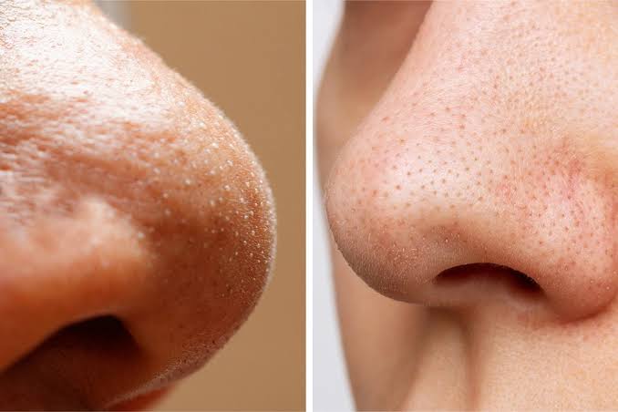 Whitehead (closed comedone) — small white bump under the skin caused by clogged pores without inflammation.
