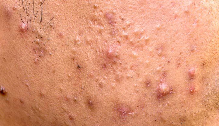 Papule – small red acne bump without pus, tender and slightly raised on the skin."
