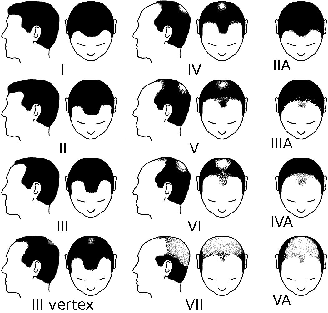 Norwood-Hamilton scale showing stages of male pattern baldness from I to VII"
