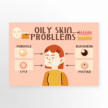 Oily acne prone skin with visible blackheads and pustules
Cystic acne and clogged pores on oily facial skin
Blackheads and inflamed pimples caused by excess sebum
Acne formation on oily skin during hot weather
